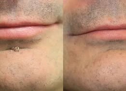 🔥 LAST DAY SALE-80% OFF✨Curalona®2-in-1 Microneedle & Hydrocolloid Patch🍀| Removes Raised Moles, Acne, Flat Warts & Skin Tags | Helps Improve Wrinkles, Scars & Blemishes | Invisible Patches for Face & Body
