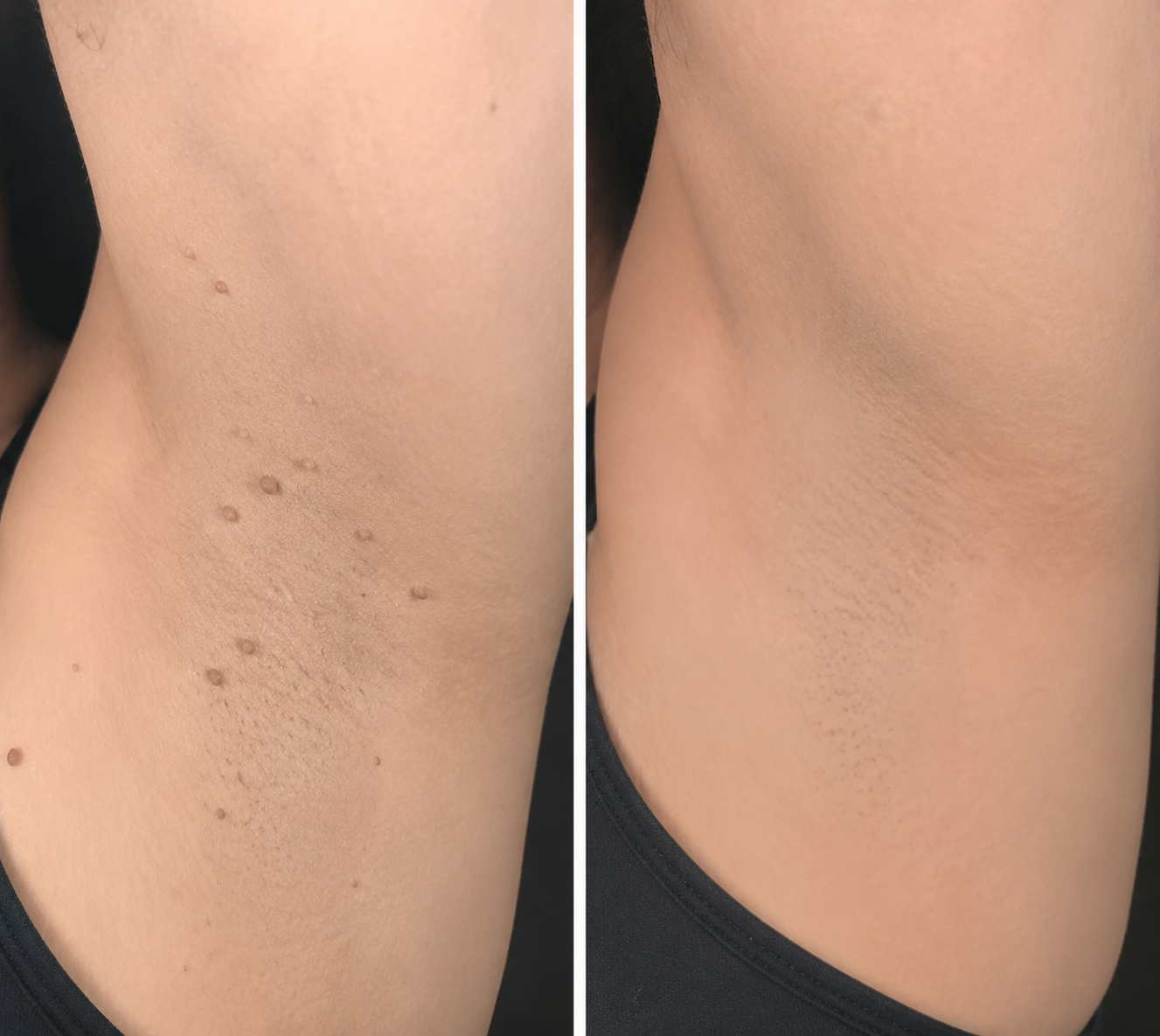 🔥 LAST DAY SALE-80% OFF✨Curalona®2-in-1 Microneedle & Hydrocolloid Patch🍀| Removes Raised Moles, Acne, Flat Warts & Skin Tags | Helps Improve Wrinkles, Scars & Blemishes | Invisible Patches for Face & Body