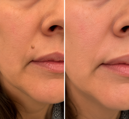 🔥 LAST DAY SALE-80% OFF✨Curalona®2-in-1 Microneedle & Hydrocolloid Patch🍀| Removes Raised Moles, Acne, Flat Warts & Skin Tags | Helps Improve Wrinkles, Scars & Blemishes | Invisible Patches for Face & Body